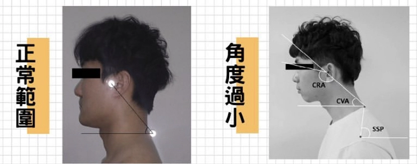 圓肩、脖子前傾怎麼辦？物理治療師：肌肉失衡3招改善