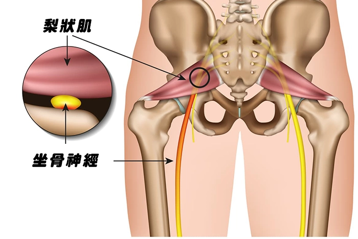 梨狀肌症候群介紹