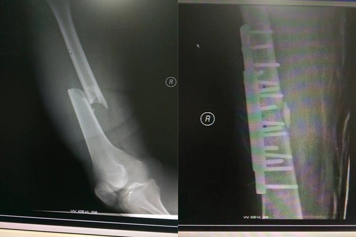 車禍後腿部閉鎖性骨折