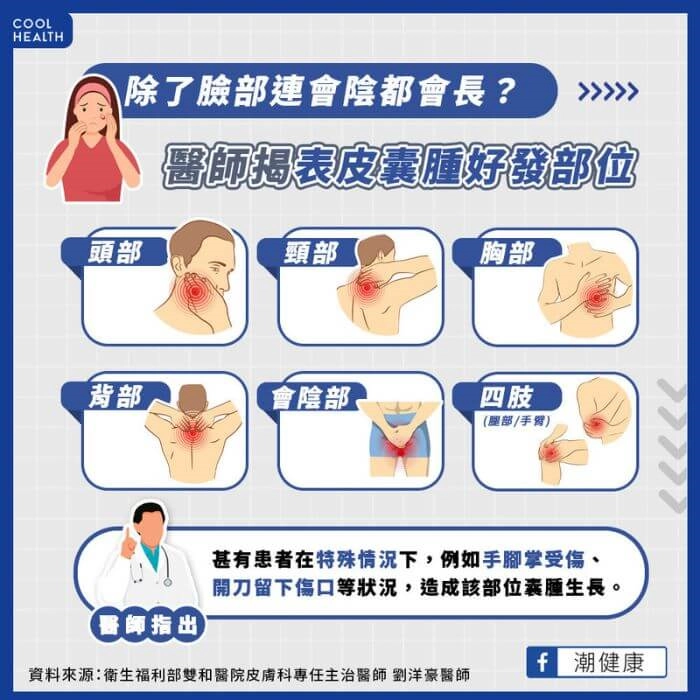 粉瘤好發季節與部位