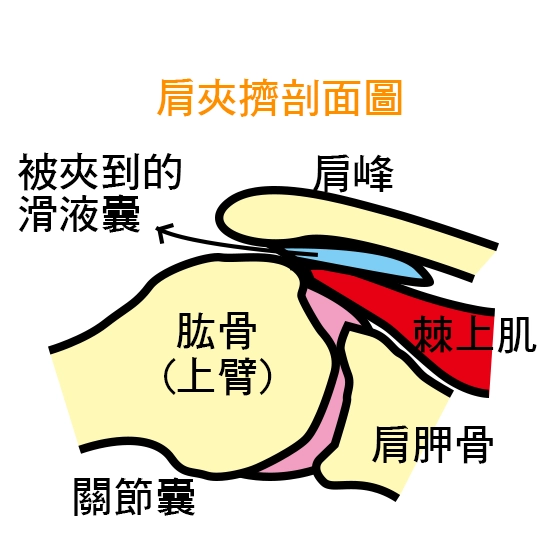 肩夾擠症候群