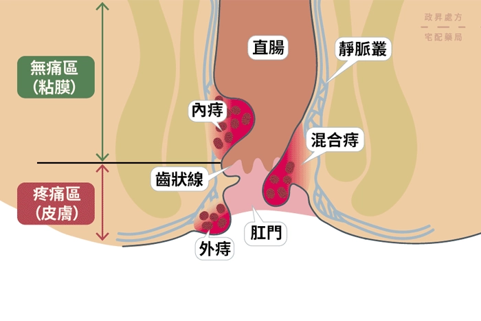 內外痣示意圖