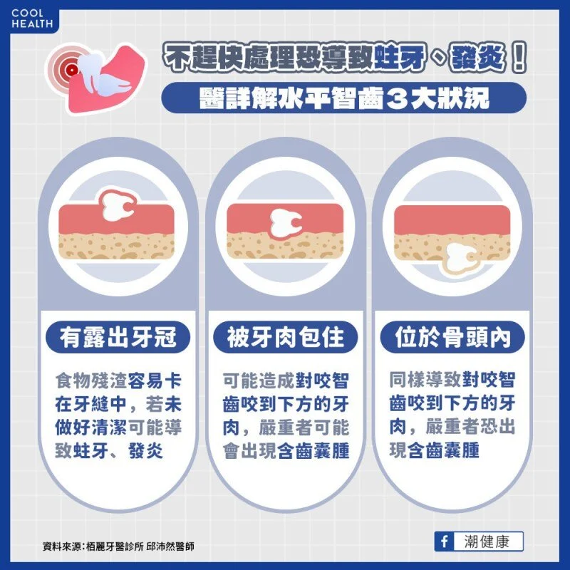 水平智齒三種型態