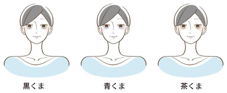 黑眼圈形成原因