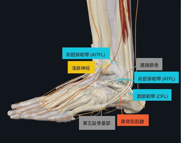 腳踝扭傷外側