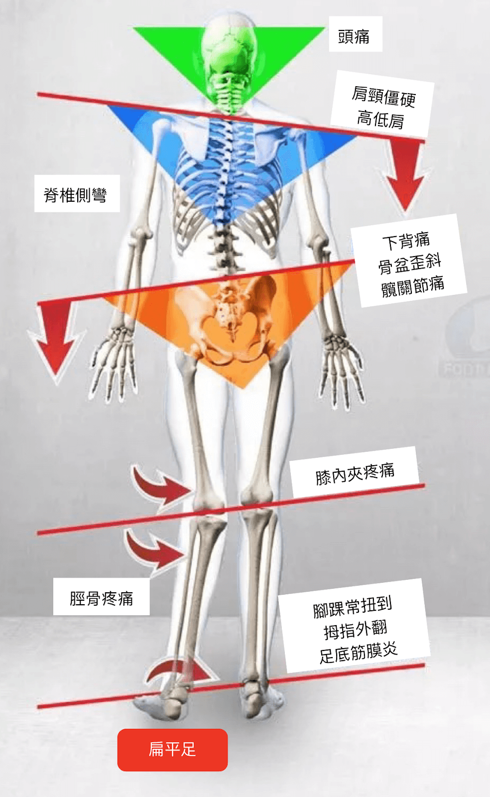 扁平足如何影響身體